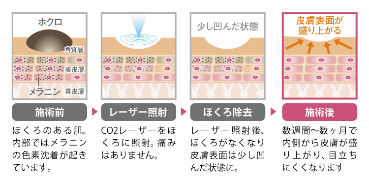 co2レーザー治療