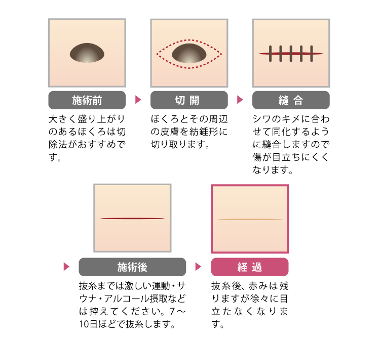 co2レーザー治療